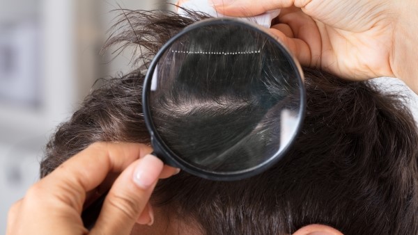 Посещение специалиста при тотальной и универсальной алопеции Кожа головы и волосы под лупой