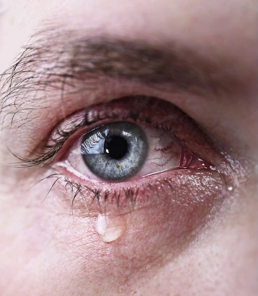 Слеза течет из глаза Слезящийся глаз вблизи