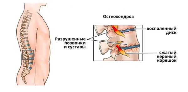 Лечение ушиба позвоночника