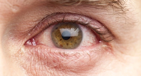 Красный глаз вблизи