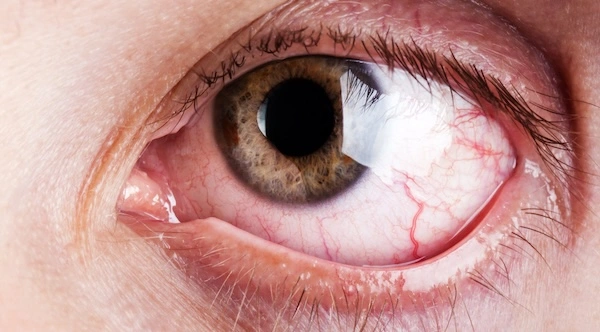 Красный глаз с прожилками