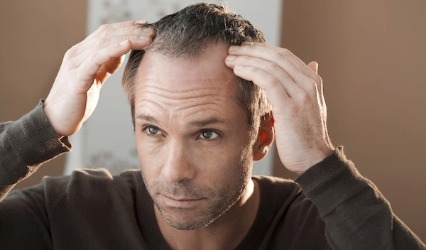 Мужчина с залысинами Мужчина с признаками андрогенетической алопеции