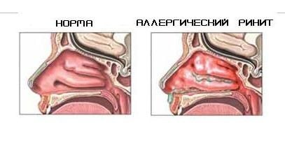 Аллергический ринит - причины и лечение