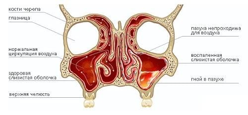 Хроническая заложенность носа: почему возникает, чем грозит и как лечится