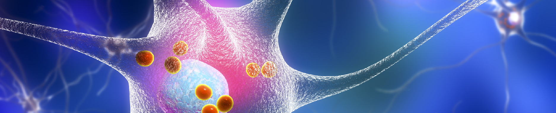 Parkinson's disease. 3D illustration showing neurons containing Lewy bodies, small red spheres which are deposits of proteins accumulated in brain cells that cause their progressive degeneration.