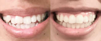 Before/after treatment. What's corrected: Improved smile line