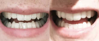 Before/after treatment. What's corrected: Achieved a symmetrical smile by fixing midlines and overbite
