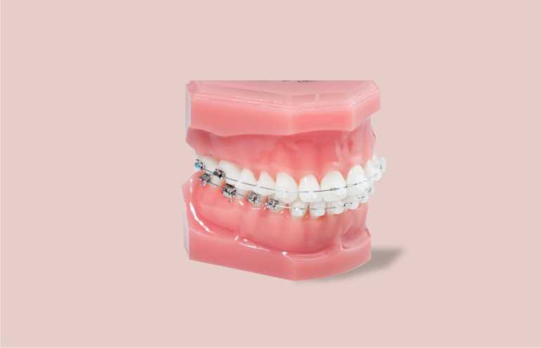 Clear Aligners For Adults