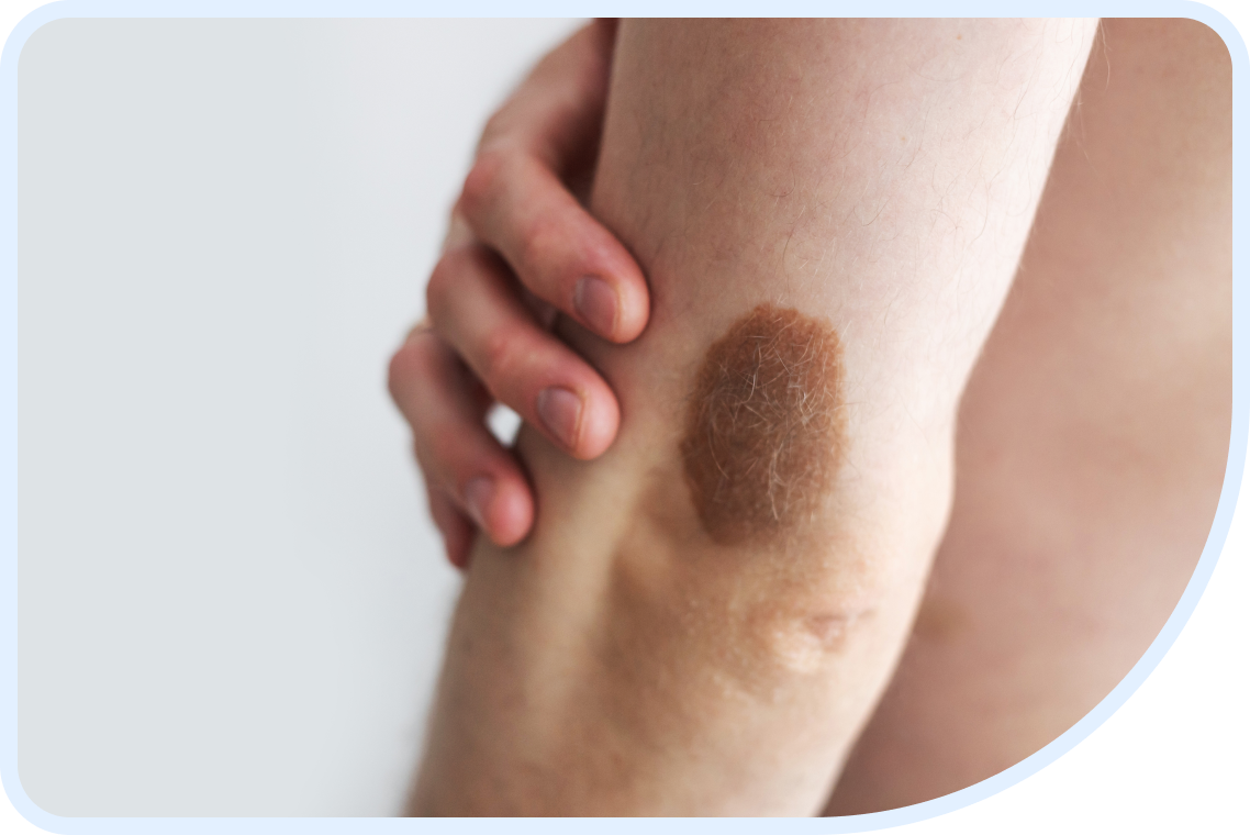 carcinoma-complications-2