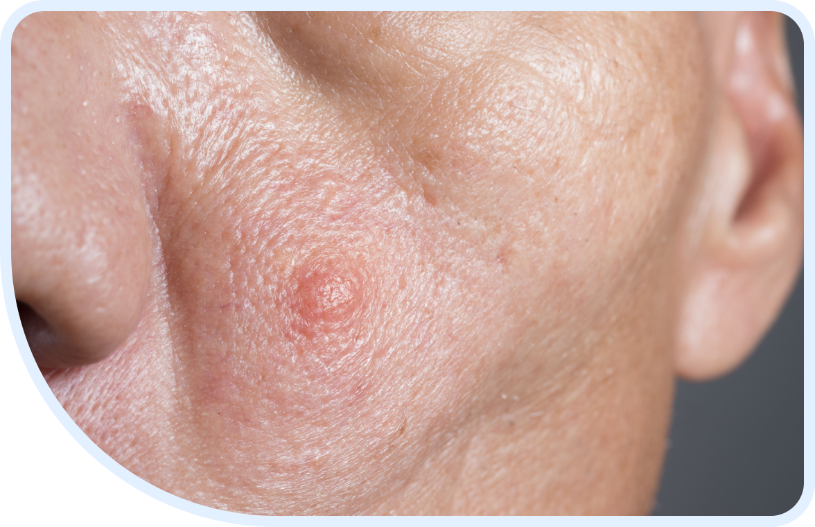 carcinoma-complications-1