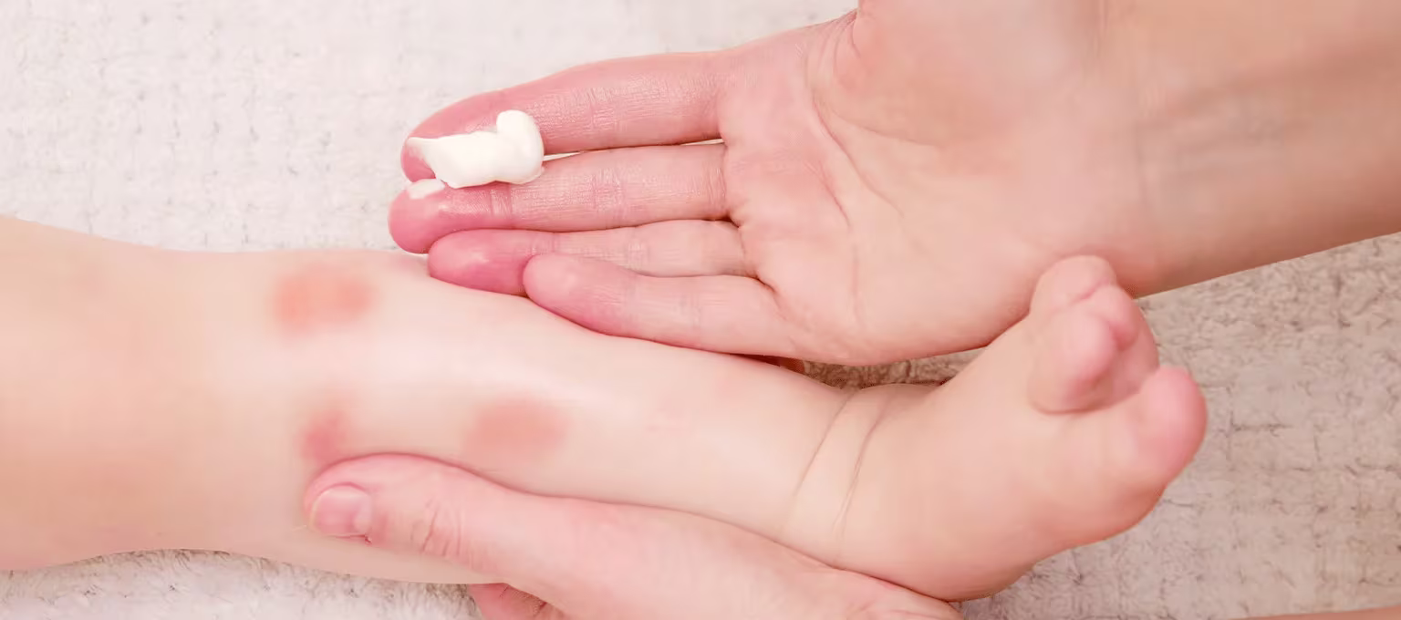 Bebé con dermatitis atópica