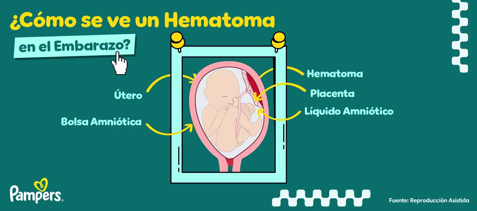 ¿A qué se debe un hematoma en el embarazo?