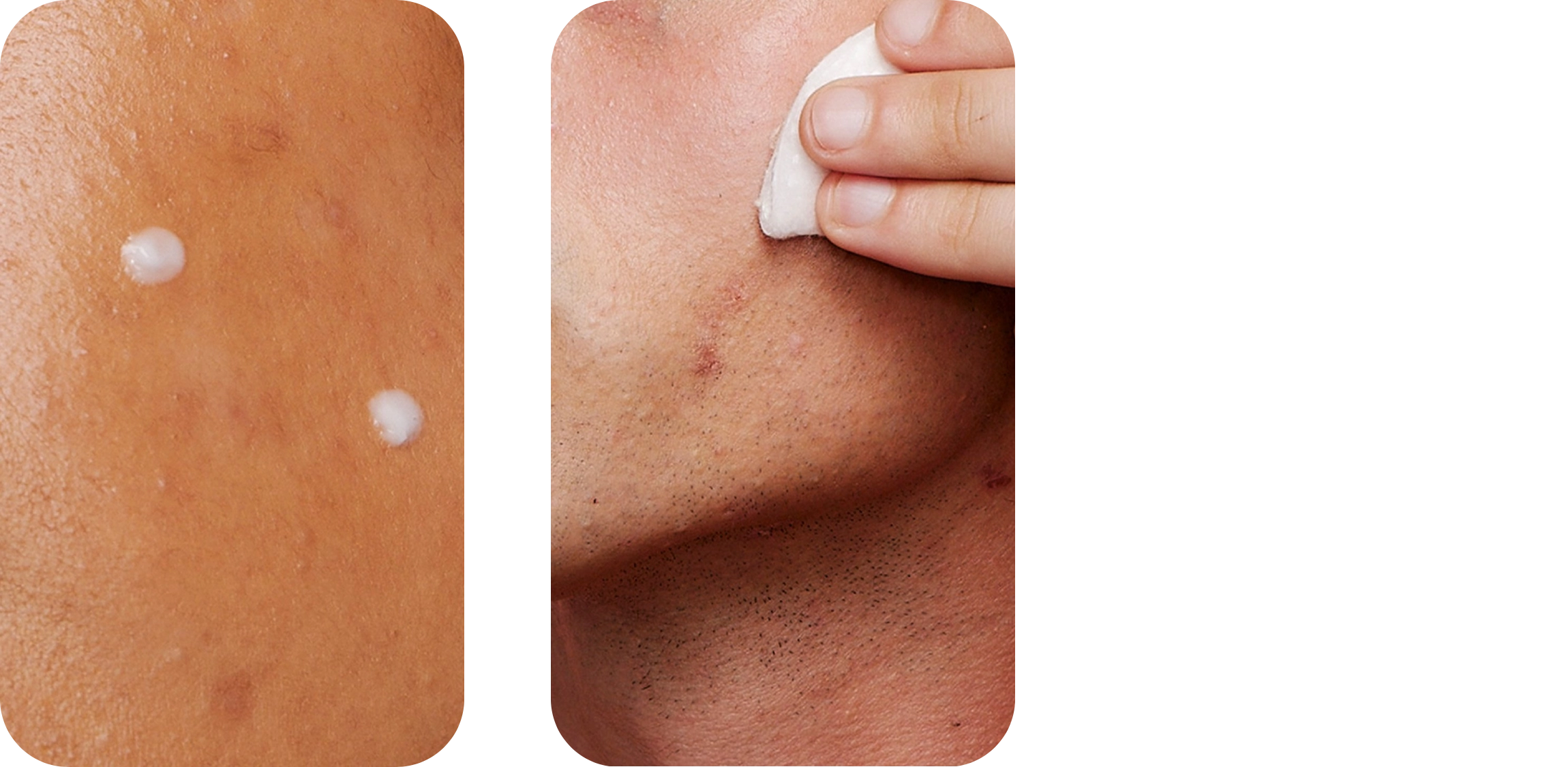 Left side shows two white cream dots on brown skin; right side features a hand applying a white pad on facial skin, suggesting a skincare routine. Black background.