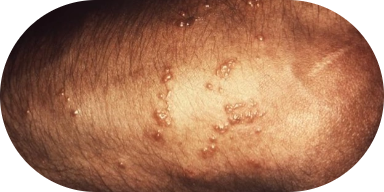 Poison Ivy, Oak, and Sumac Rashes: Symptoms and Treatments - Image 1 - Benadryl - en-US