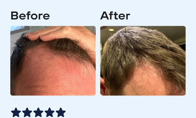 Before and after image, top of man's scalp showing signs of hair regrowth.