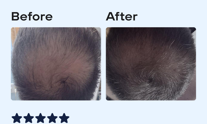 Before and After image, top of man's scalp showing signs of hair regrowth