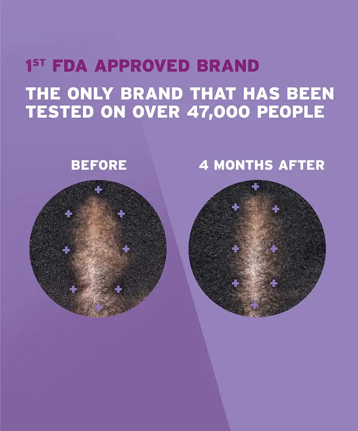 A before and after picture of a woman with dark brown hair showing hair regrowth.