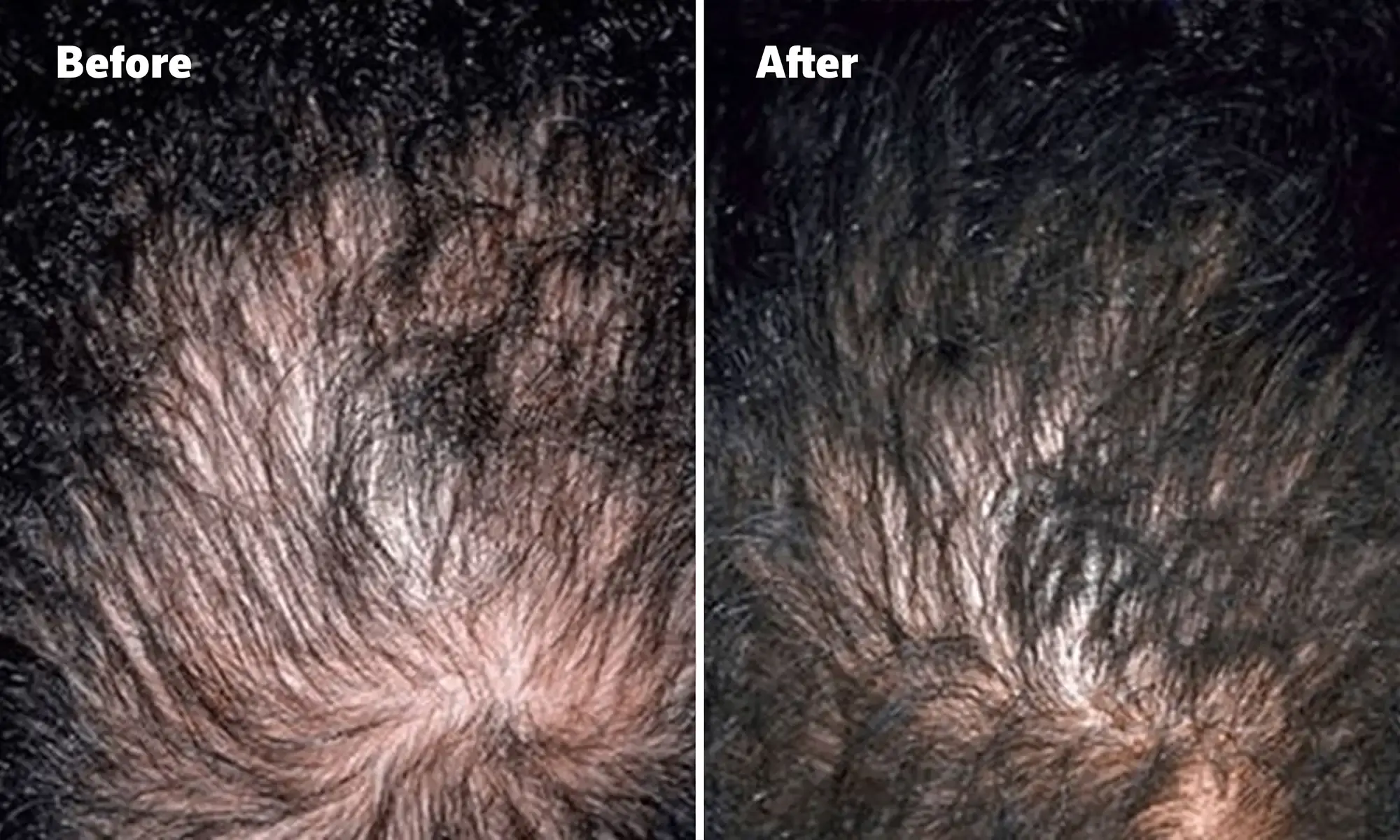 Before and after image, top of man's scalp is visible due to balding.