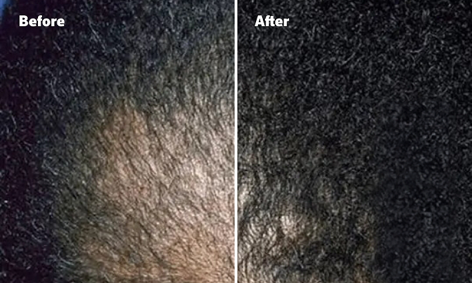 Before and After image, top of man's scalp is visible due to balding.