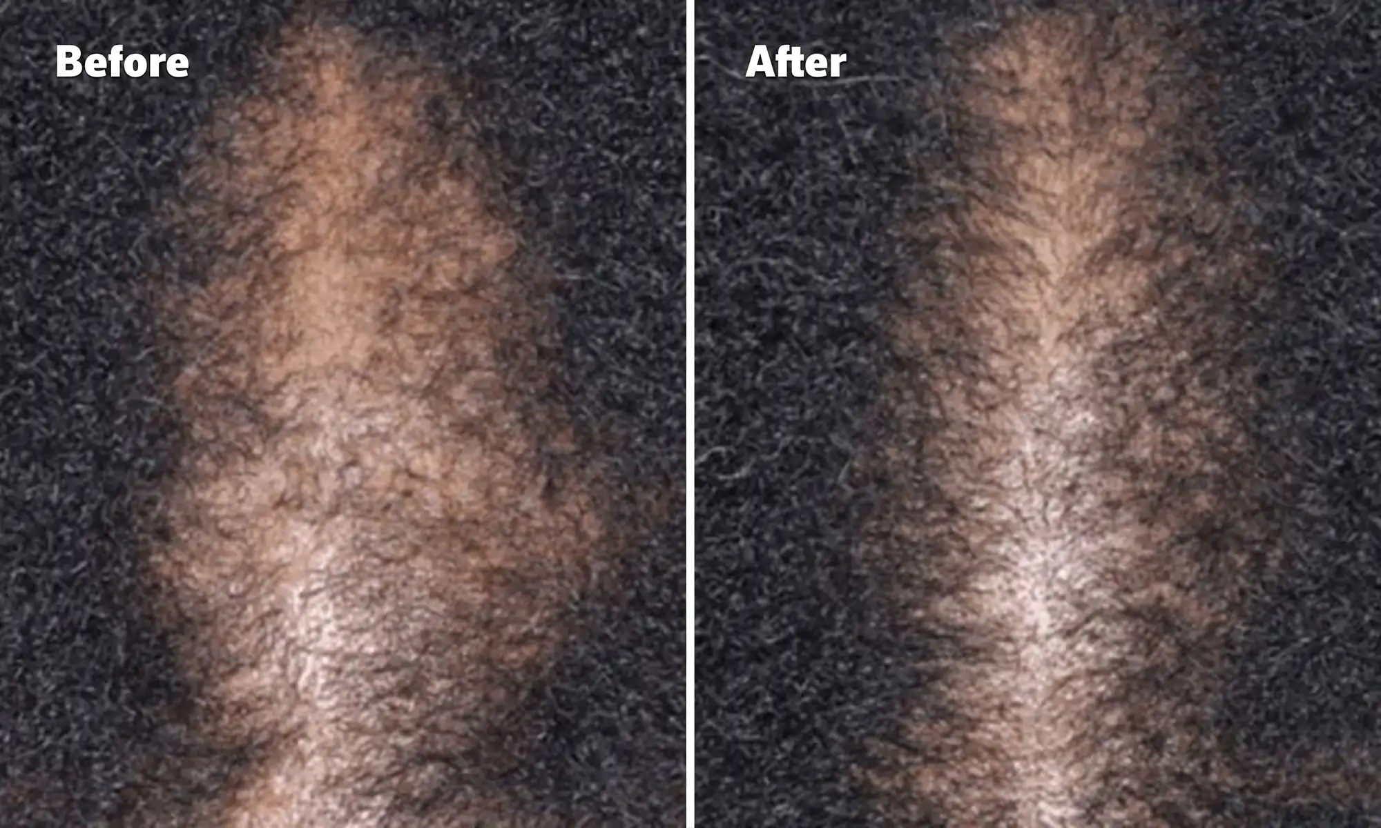 Before and After image,  top of woman's scalp showing signs of hair regrowth.