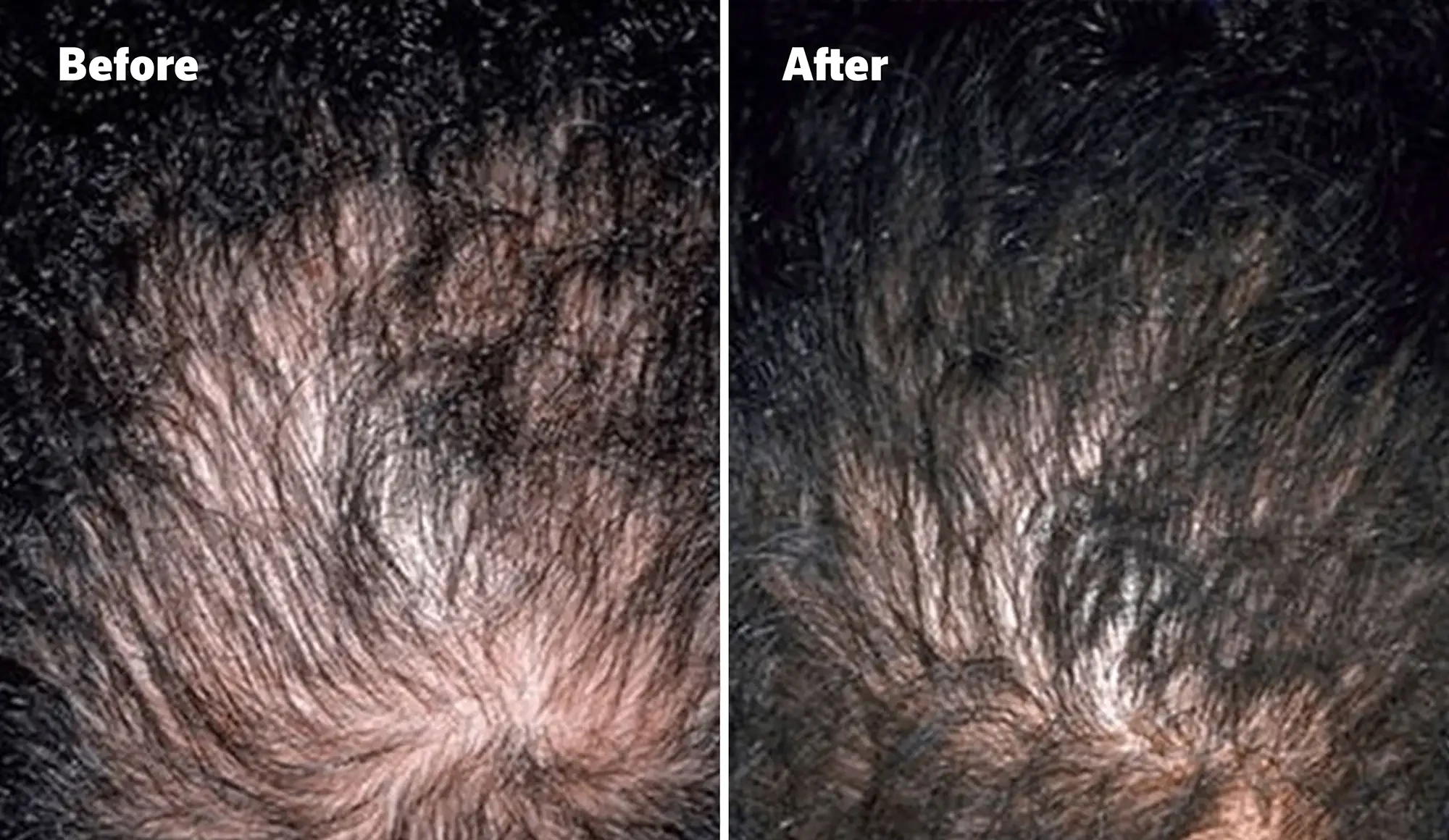 Before and after image, top of man's scalp is visible due to balding.