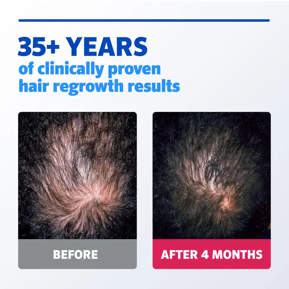 Before and after image of man with brown hair showing visible hair regrowth after 4 months of using Men’s ROGAINE® treatments.