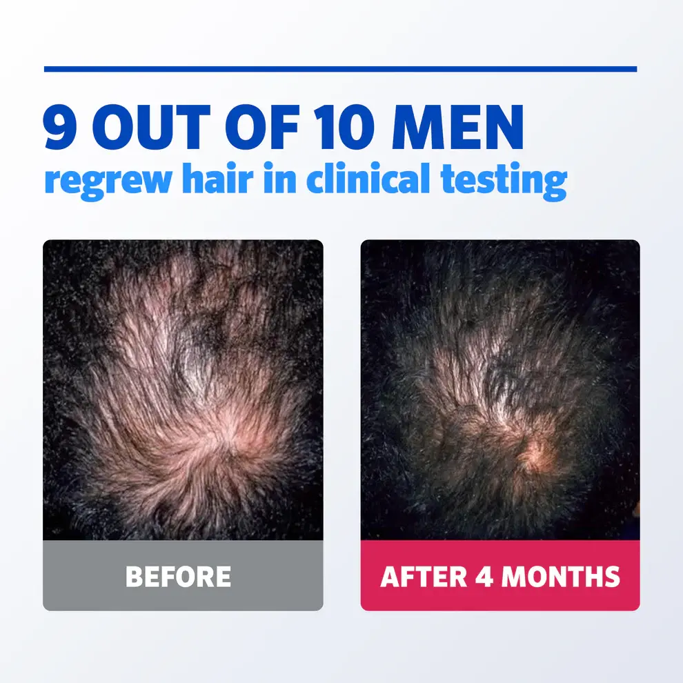 Before and after image of man with brown hair showing visible hair regrowth after 4 months of using Men’s Rogaine treatments.