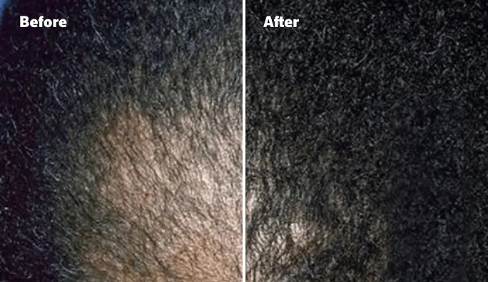 Before and After image, top of man's scalp is visible due to balding. Before and After image, top of man's scalp is visible due to balding.