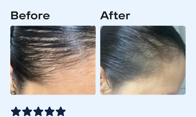 Before and After image, top of woman's scalp showing signs of hair regrowth.
