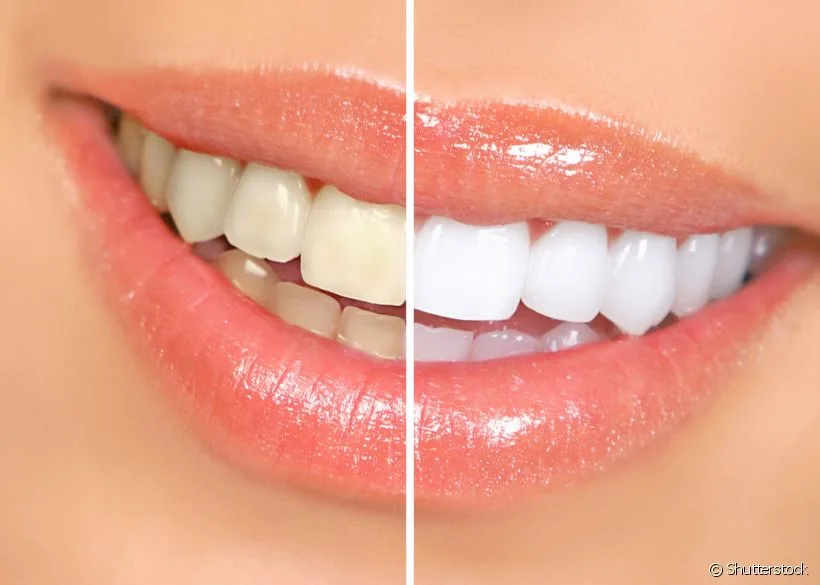 travesura Máxima en términos de Cómo blanquear los dientes sin dañar tu salud bocal