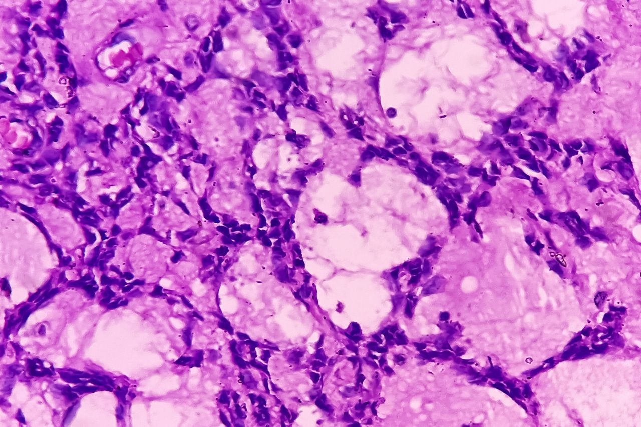 Afami-cel Shows Promising Results in Synovial Sarcoma