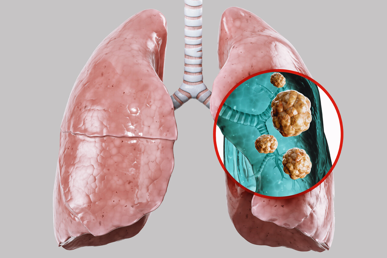 腎臓内科Controversy FDA Approves Dato-DXd (Datroway) for EGFR-Positive Non-Small