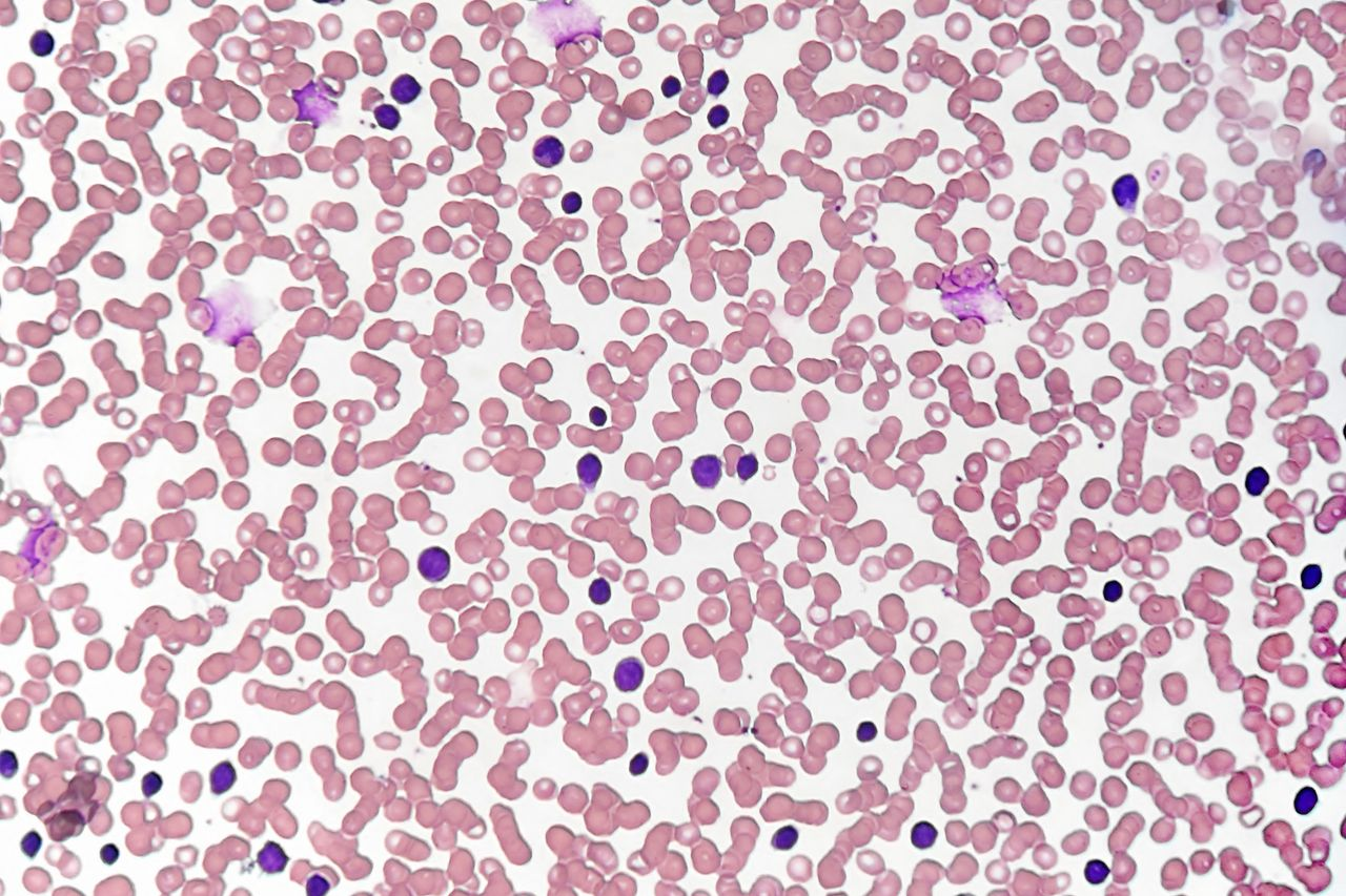 High-Risk CLL: Clinical Case and Management
