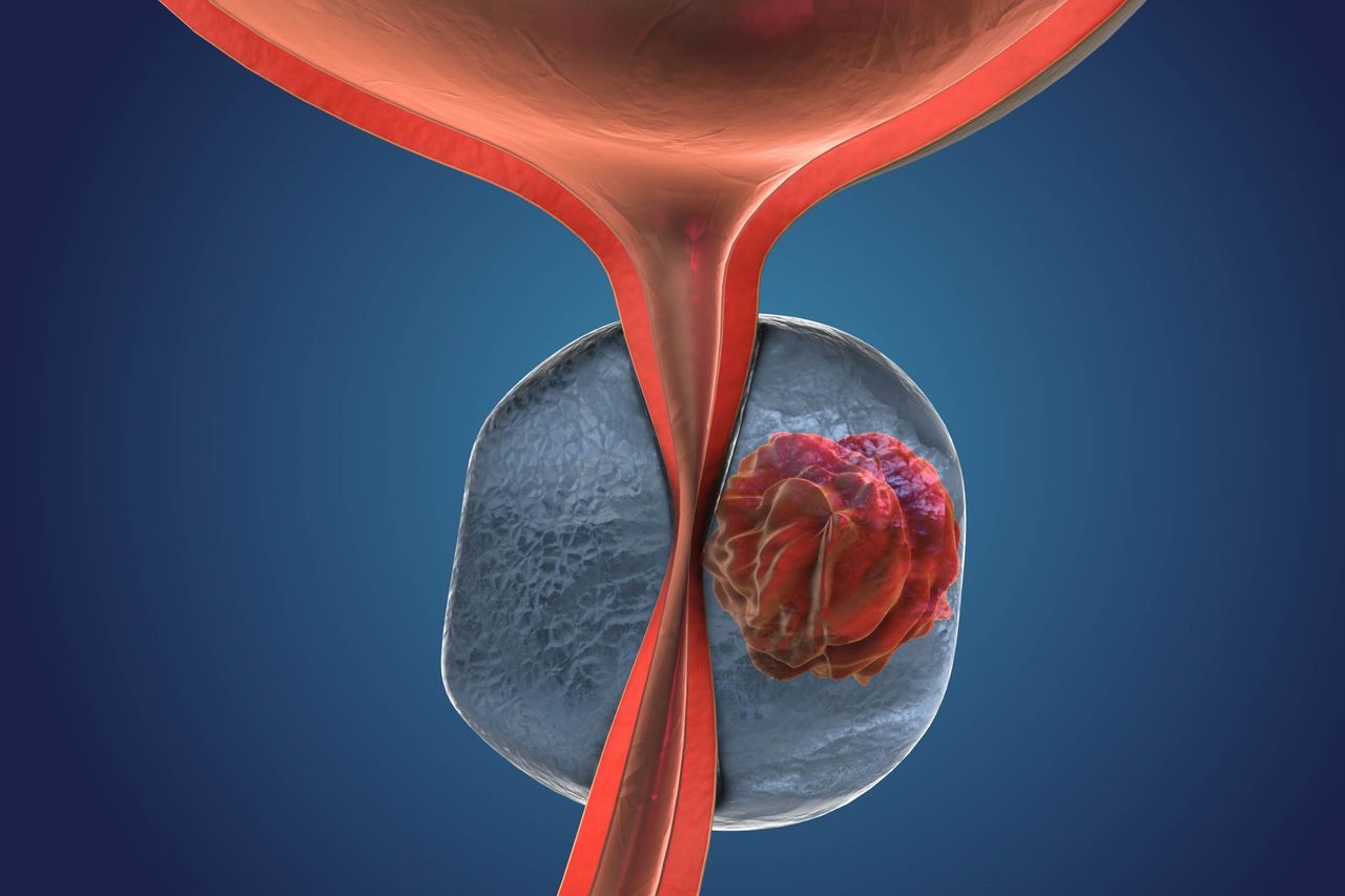 Talazoparib Plus Enzalutamide for Metastatic Prostate Cancer