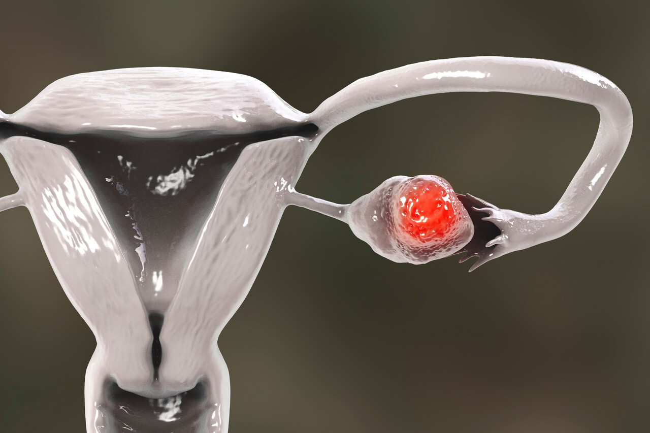 Phase 3 Survival Data Show Combo Regimen Is a “Game Changer” for Ovarian Cancer