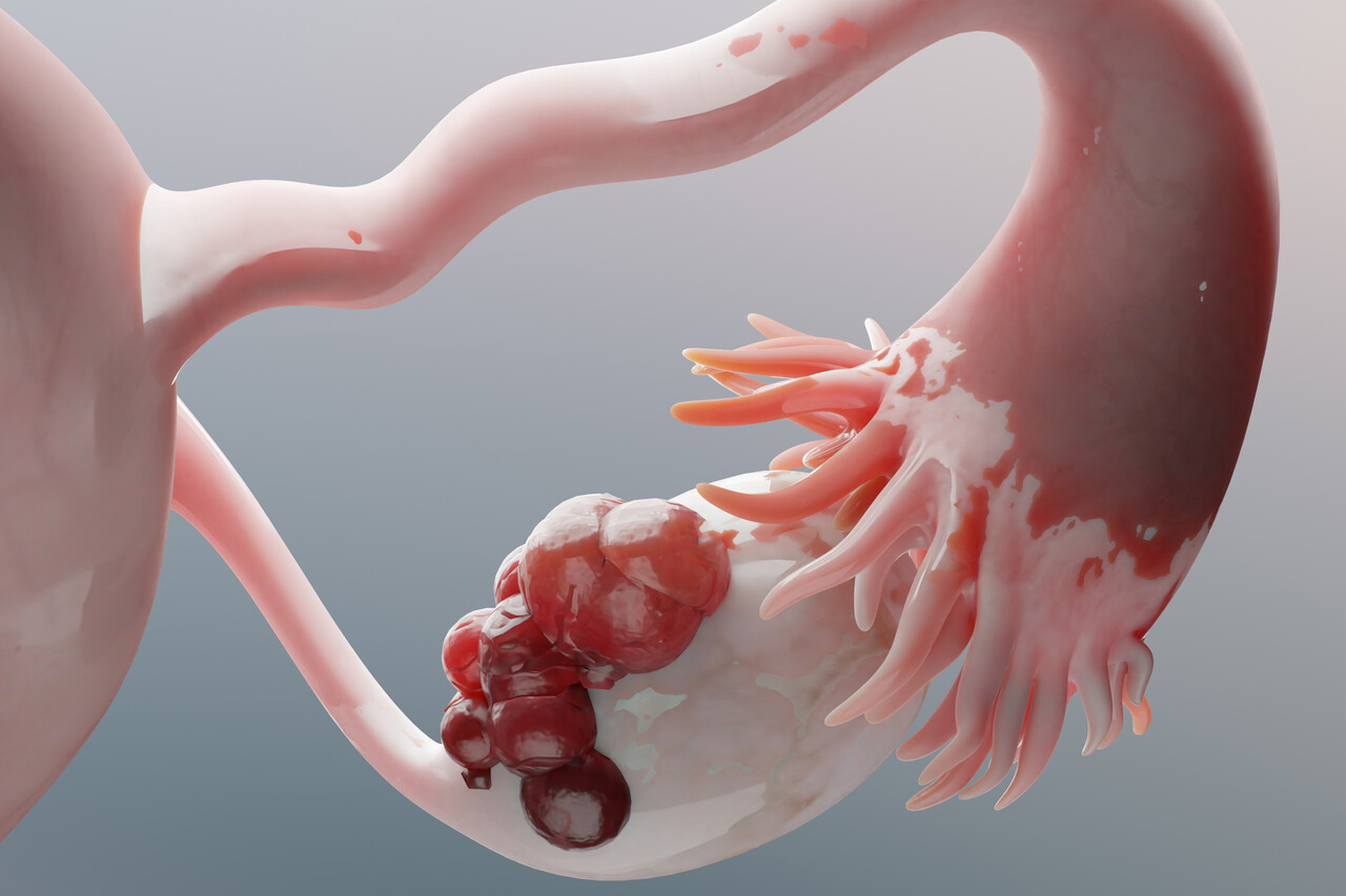 For First Time, Definitive Standard Established for Low-Grade Serous Ovarian Carcinoma