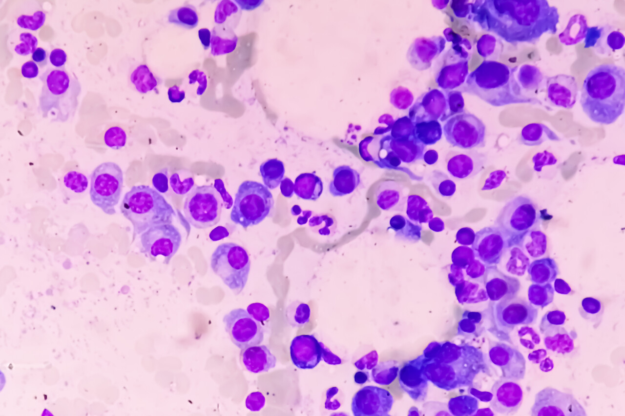 Isatuximab Plus VRd New Standard for TransplantIneligible Newly