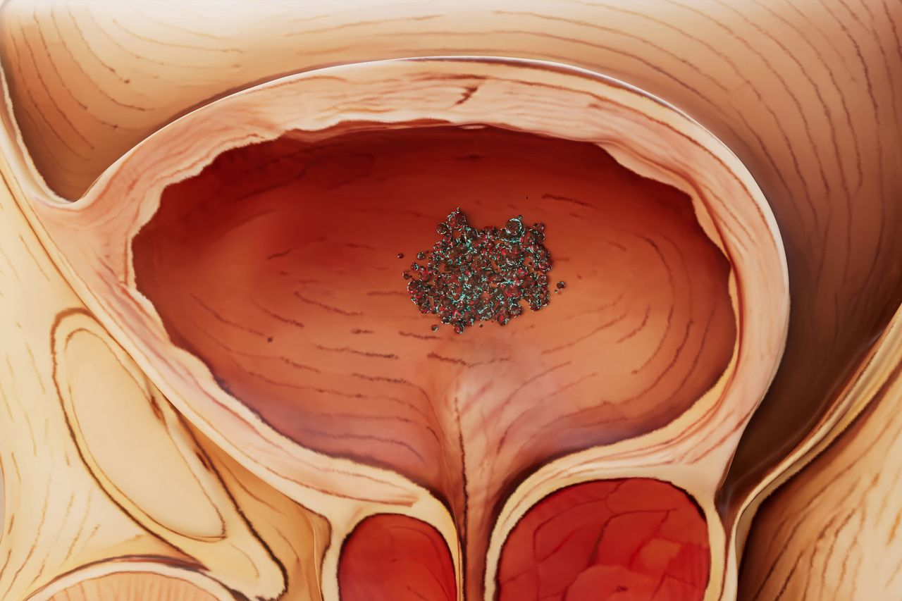 Biomarkers Predict BCG Failure in High-Risk Bladder Cancer