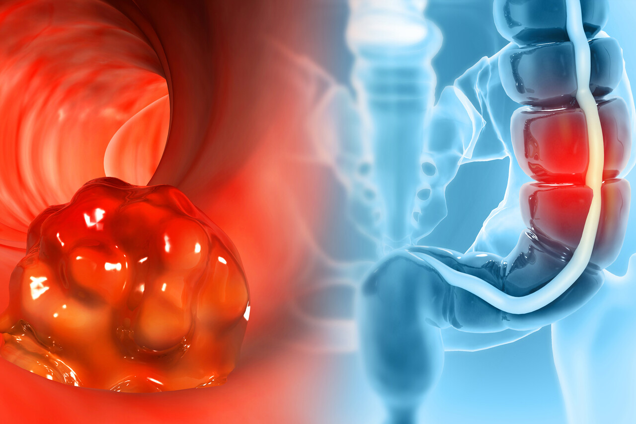 Combo First to Show Overall Survival Benefit in Certain Colorectal Cancers: STELLAR-303 Data at ESMO 2025