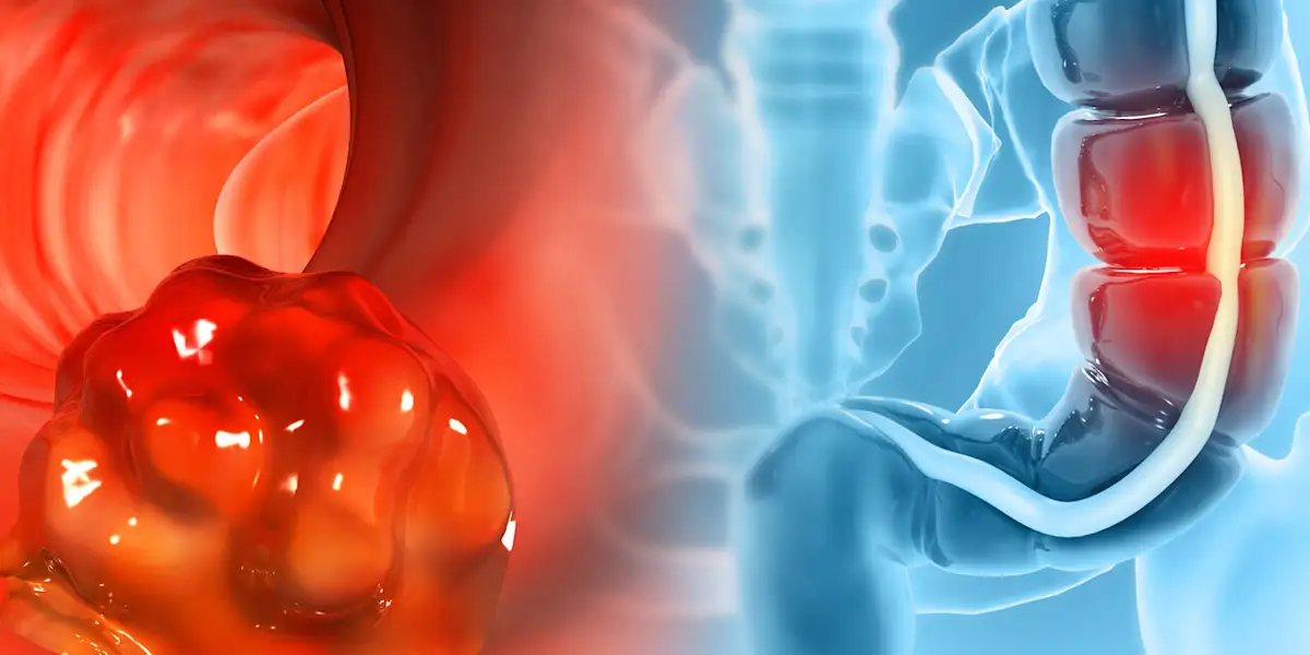 Combo First to Show Overall Survival Benefit in Certain Colorectal Cancers: STELLAR-303 Data at ESMO 2025