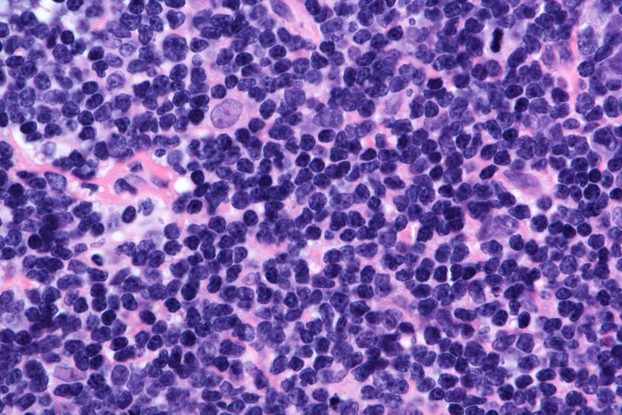Real-World Liso-cel Data Show High Response Rates in R/R MCL