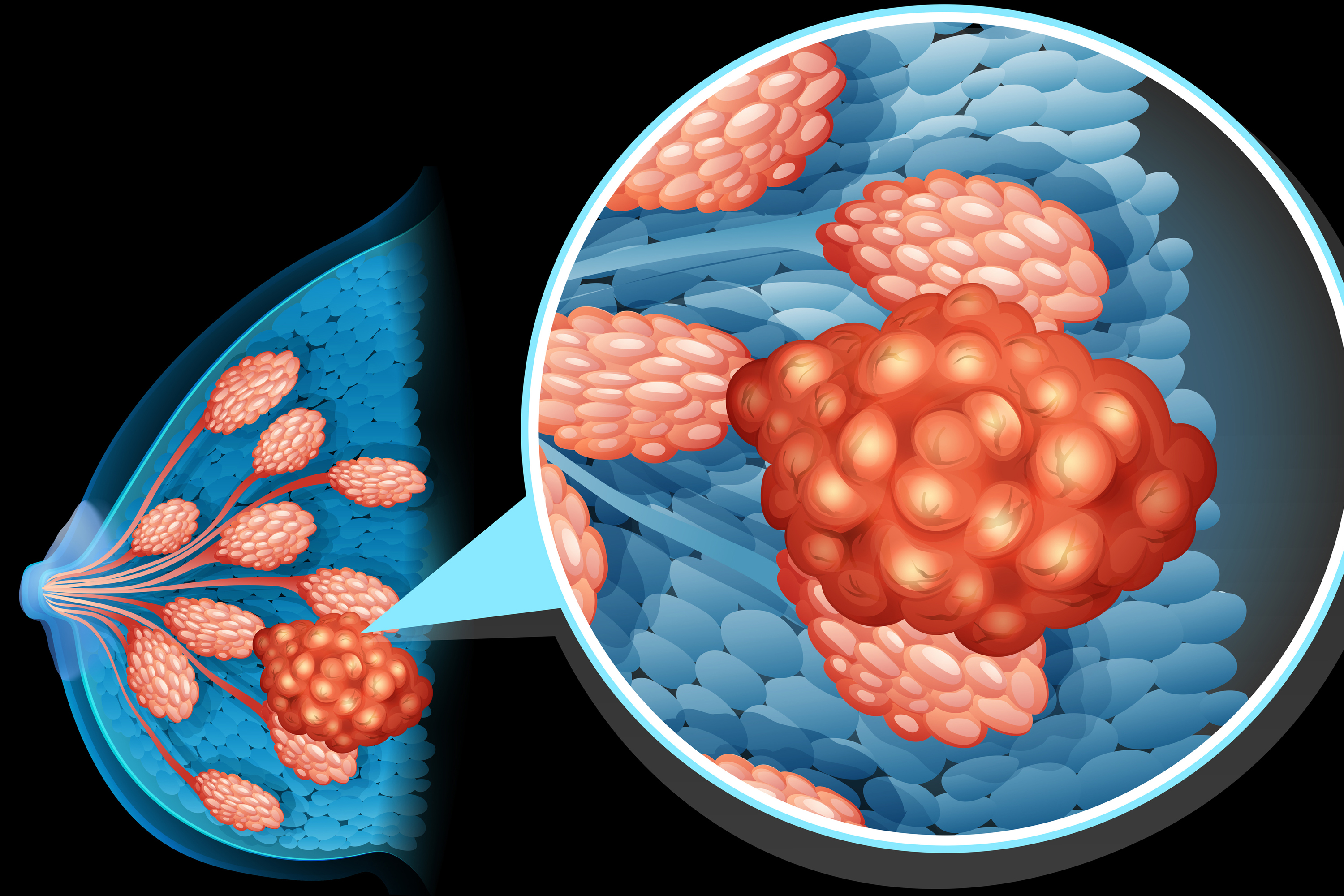 New Standard of Care in Triple-Negative Breast Cancer?
