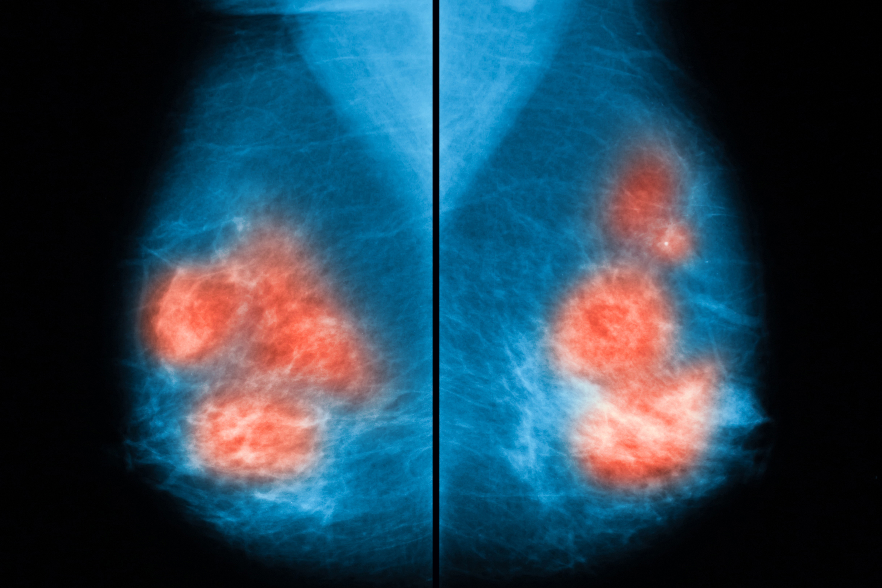 健康・医学 Breast Cancer Trastuzumab Deruxtecan Maintains Durable QOL in HER2+ Breast