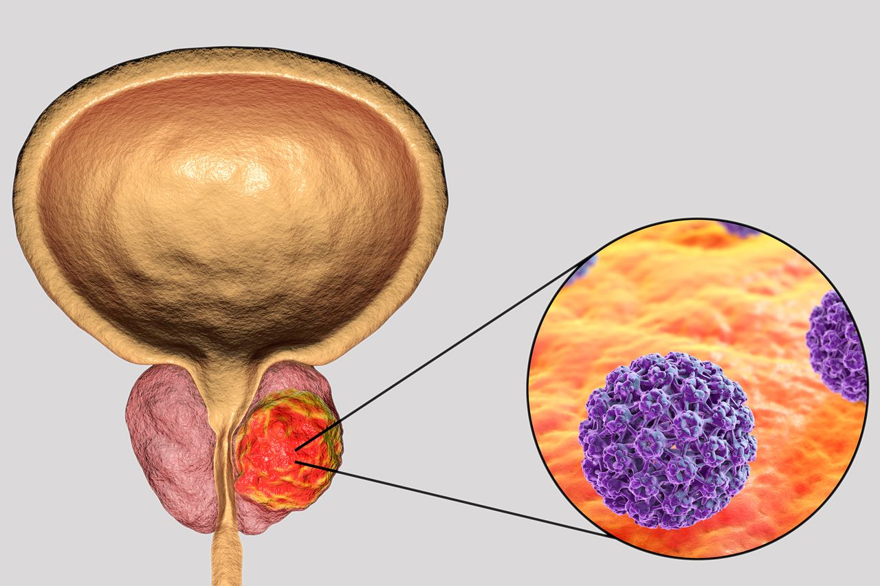 Latest Advances in Castration-Sensitive Prostate Cancer