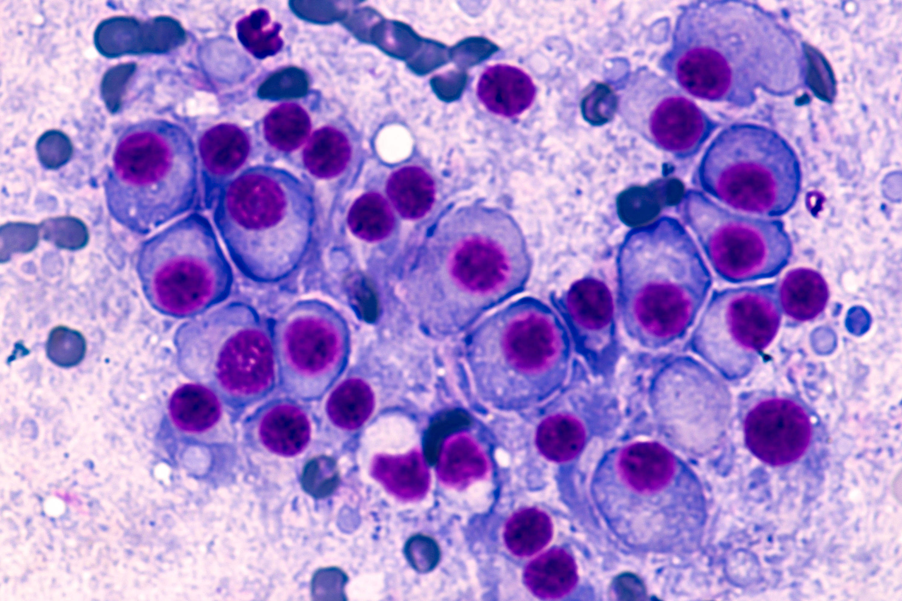 Миеломная болезнь костный мозг. Костный мозг при множественной миеломе. Цитологическое исследование крови и костного мозга.