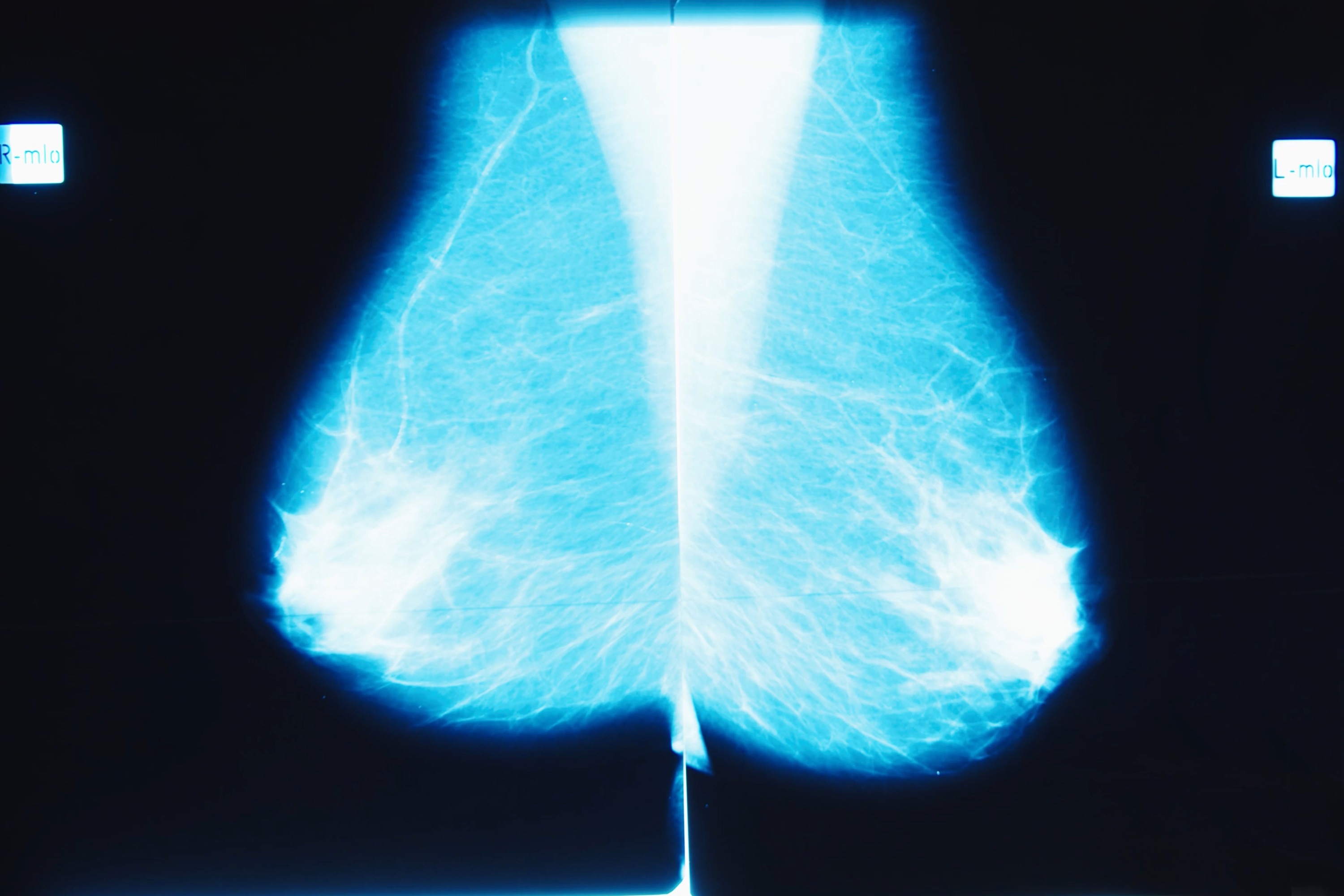 ADC Improves Invasive Disease-Free Survival in Breast Cancer: Research ...