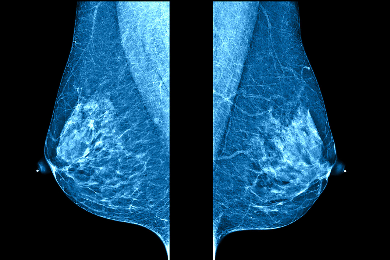 FDA Approves Inavolisib (Itovebi) Combination for Advanced Breast Cancer