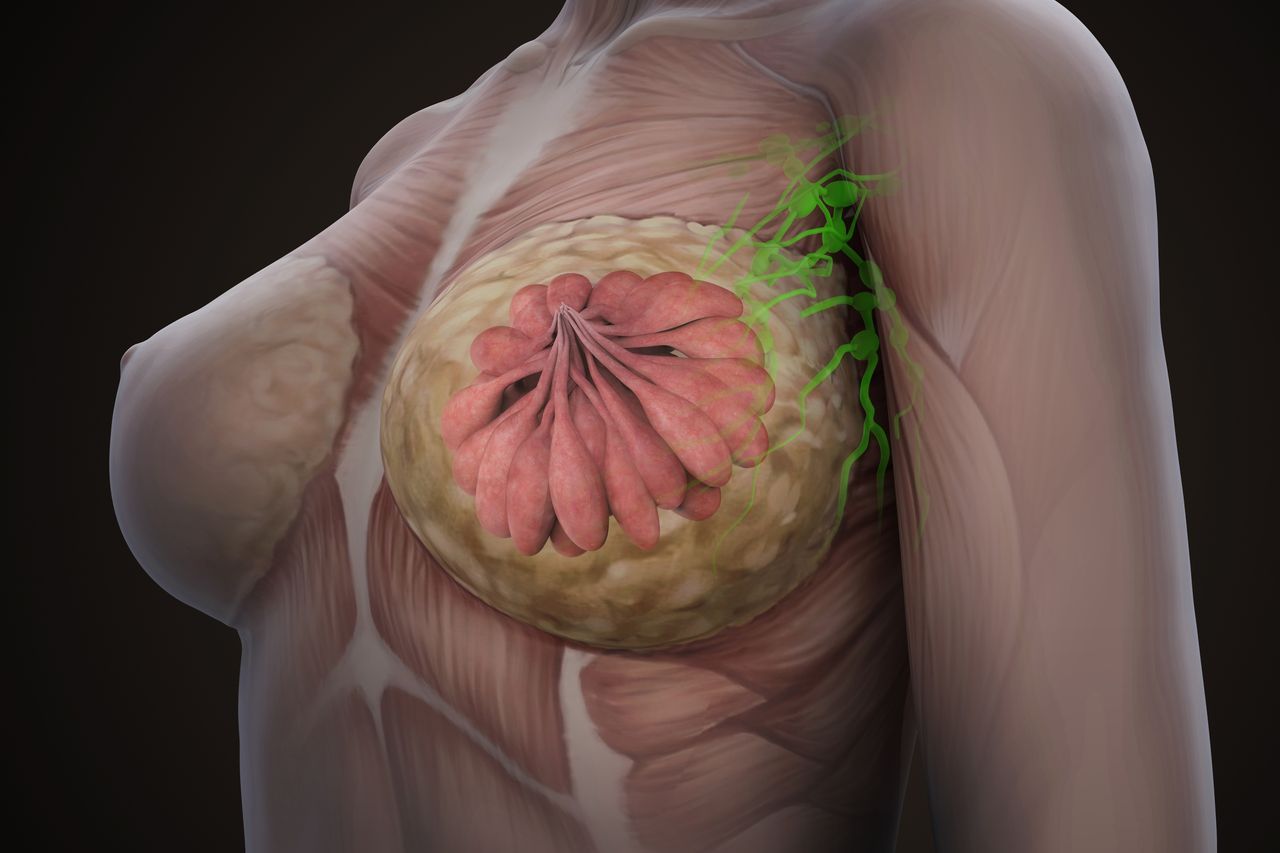 Izalontamab Brengitecan Improves Survival in Triple-Negative Breast Cancer