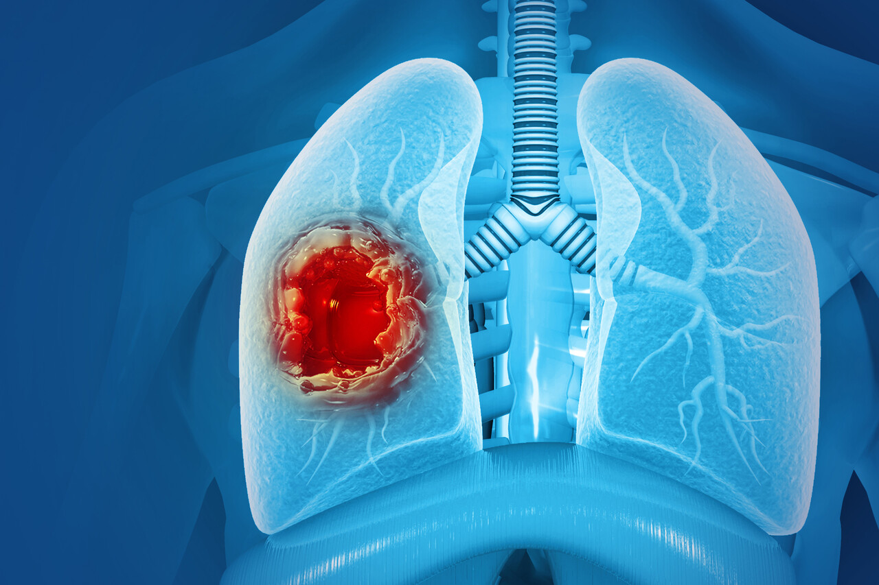 Tumor Adding Chemo to Osimertinib (Tagrisso) Doubles PFS in EGFR-Mutated