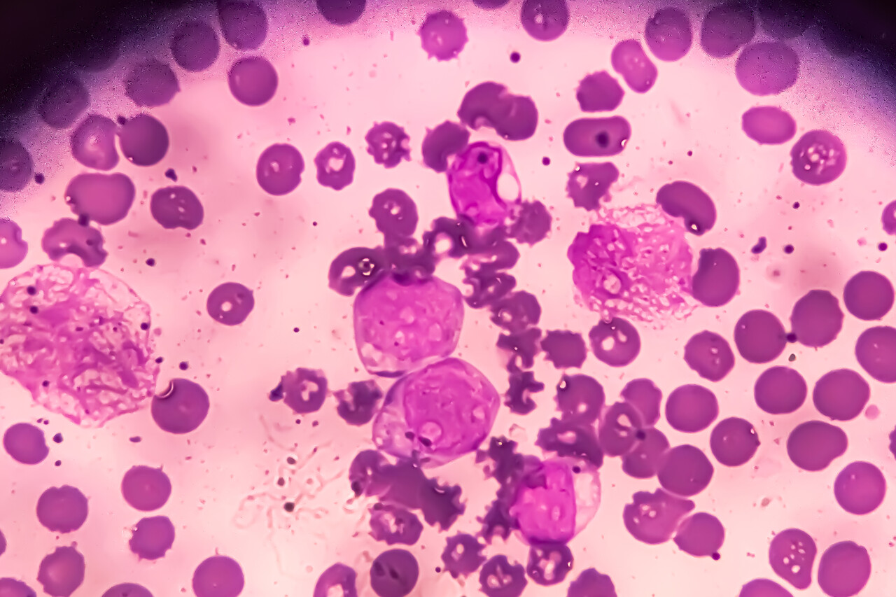 Data Back New Surrogate Endpoint to Accelerate AML Drug Development